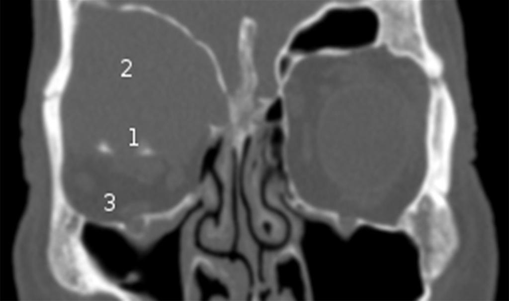 166 Otorynolaryngologia 2017, 16(4): 164-169 Ryc. 1. Przekrój czołowy oczodołów, badanie TK z dnia 08.01.2017 r.