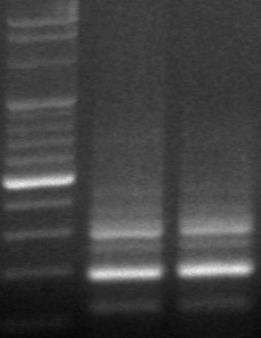 Przypadek III Podczas obchodu obserwacja higieny protezy Kontaminacja protezy zębowej przez prątki atypowe Dochodzenie epidemiologiczne wykazało identyczny