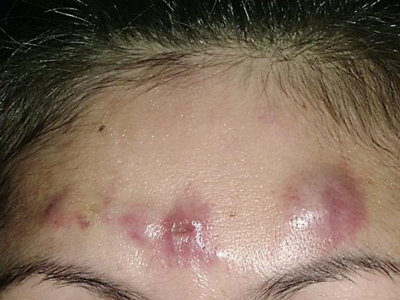 Mycobacterium