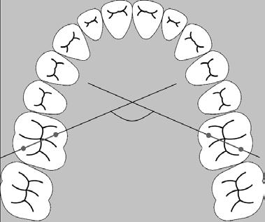 Leczenie za pomocą ekspandera niklowo tytanowego 329 Ryc. 1. Przednia i tylna szerokość górnego łuku zębo wego (według Ponta) Fig. 1. Interior and posterior width of upper dental arch (by Pont) Ryc.