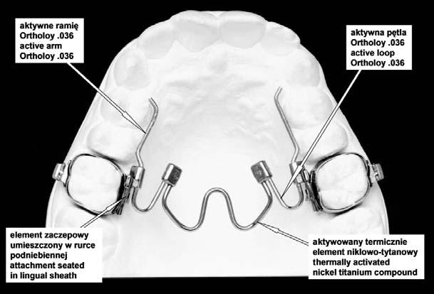 Rotation of upper first molars charakteryzuje się dużą giętkością w niższych tem peraturach i może być dowolnie kształtowany, pod czas gdy w temperaturze jamy ustnej działa siłą sta łą około 350 G