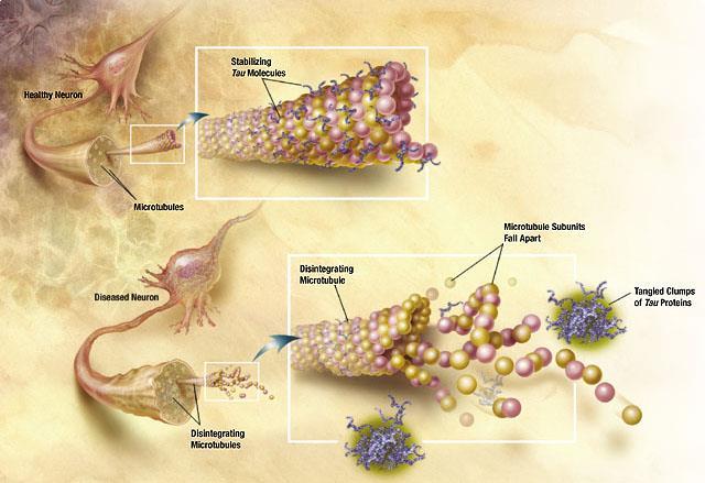 sploty neurofibrylarne (białko tau τ) norma patologia białko tau wiąże białka tworzące
