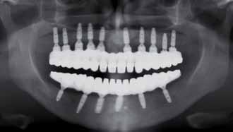 W przypadku korzystania z Atlantis ISUS, modele z analogami łączników lub implantów wraz z ustawionymi zębami akrylowymi na tych modelach przesyłane są bezpośrednio do centrum projektowania w Szwecji.