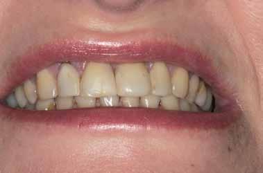 _skaner wewnątrzustny Przywrócenie estetyki uśmiechu w odcinku przednim szczęki przy pomocy technologii CAD/CAM Smile aesthetics improvement in the area of upper front teeth using the CAD/CAM