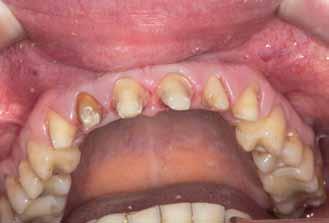dentystycznym, zadecydowano wykonać 6 estetycznych koron pełnoceramicznych na zęby 13-23 z materiału IPS