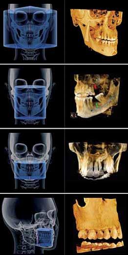 _CBCT Tomografia stożkowa innowacyjny system obrazowania Cone-beam computed tomography innovative imaging system Autor_ Jakub Baran Streszczenie: Artykuł traktuje o zastosowaniu tomografii