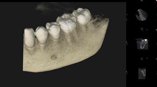 _CBCT Ryc. 11 Ryc. 11_Dawka, jakiej poddawany jest pacjent podczas tomografii CBCT wycinkowej. pującej podczas wykonywania zwykłego zdjęcia panoramicznego (Ryc. 9-11).