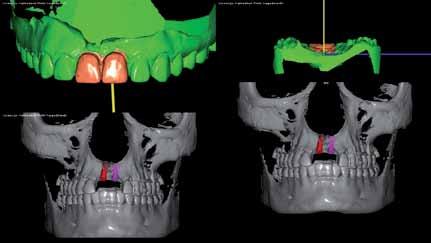 wydrukiem klucza implantologicznego pozycjonującego przy pomocy programu DDS-Pro Implant w najbardziej optymalnym dla niego miejscu i rozmiarze.