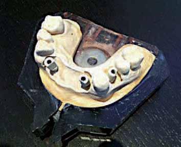 _CAD/CAM fixed prosthetics CAD/CAM fixed prosthetics: A case report Author_Tero Rakkolainen, Finland Fig. 1 Fig. 2 Fig. 3 Fig.
