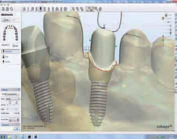 _CAD/CAM fixed prosthetics Fig. 7 Fig. 8 Fig. 9 Fig. 10 Fig. 11 Fig. 12 sections when using the 3Shape scanner for implants.