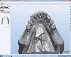 Next scanning abutments (Turun Teknohammas) were fixed on the model with screws (Fig. 4).