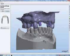 The scanning abutments on the model defined the position of the implants in 3-D space.