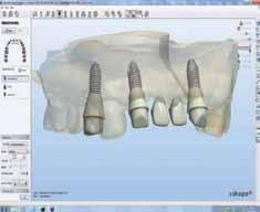 The complete CAD work model with scanning abutments and a separate gingival mask scan was shown on the screen (Fig. 6).