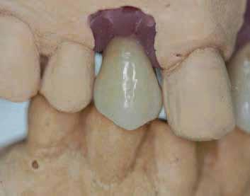 _CAD/CAM fixed prosthetics Fig. 16 Fig. 17 Fig. 18 Fig. 19 Fig. 20 Fig. 21 Fig. 16_The completed abutments accurately matched the design. Fig. 17_The veneering work was performed at the laboratory using conventional ceramic methods.