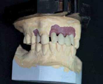 The fact that today we can mill custom-made abutments and screw-retained bridges from zir conia is the result of a cross-disciplinary effort between dental technology and engineering.