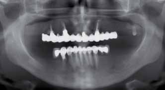 _CAD/CAM suprastruktury metalowej (lub rzadziej cyrkonowej czy kompozytowej) do powierzchni nośnych implantów dentystycznych lub łączników typu MUA