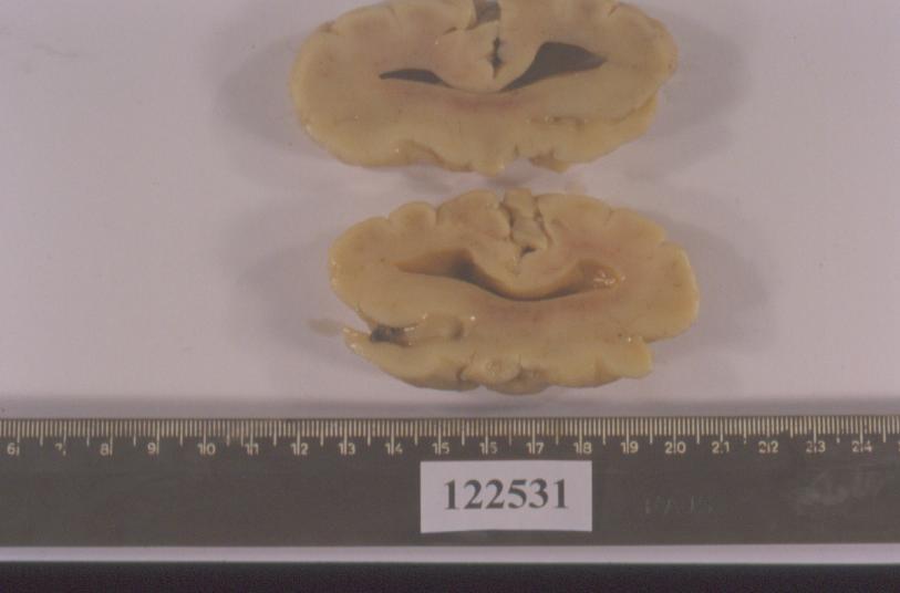 Schorzenia, w których istotną rolę odgrywa mutacja SHH lub jego szlaku sygnalizacyjnego (PTC, SMO,) 1. Holoprosencephalia (różny stopień zaburzeń) 2. Medulloblastoma: mutacje m.in.