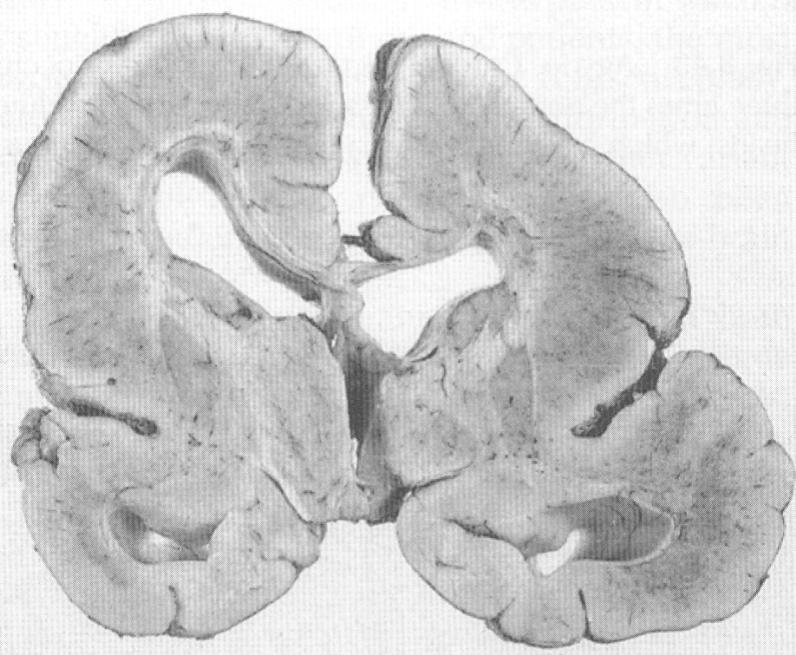 Lissencefalia przykład wady migracji radialnej Mutacja doublecortin (DCX) doublecortin X-linked Białko marker niedojrzałych neuronów, kooperujące z mikrotubulami istotne dla utrzymania integralności