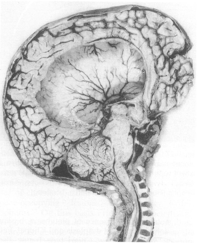 Chiari II (Arnold-Chiari) wodogłowie Mały tylny dół czaszki, Przemieszczenie robaka w dół do otw.potyl wlk.