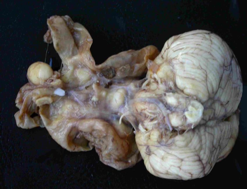 Hydranencefalia-Hydranencephaly (with