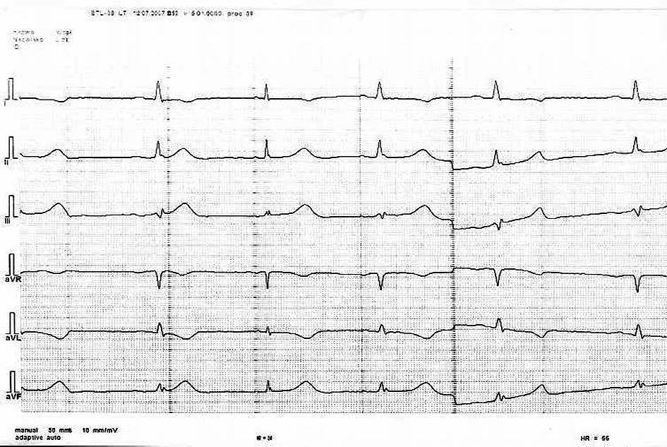 ECG after 40 days of treatment