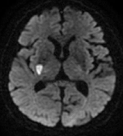 Fenotypy radiologiczne choroby małych naczyń wg STRIVE świeże małe podkorowe zawały (ang.
