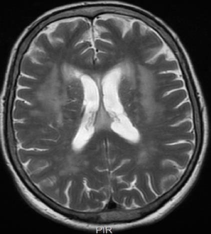 Fenotypy radiologiczne choroby małych naczyń wg STRIVE hiperintensywne zmiany istoty
