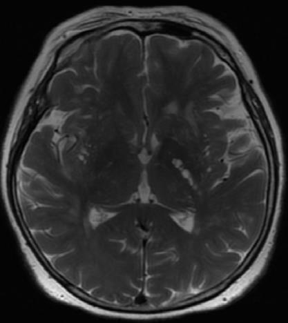 Fenotypy radiologiczne choroby małych naczyń wg STRIVE poszerzenia przestrzeni okołonaczyniowej (ang.
