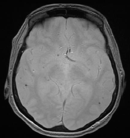 mikrokrwotoki (ang. cerebral microbleeds CMBs): średnica < 10 mm, odpowiadają makrofagom obładowanym hemosyderyną, które znajdują się w przestrzeni okołonaczyniowej.