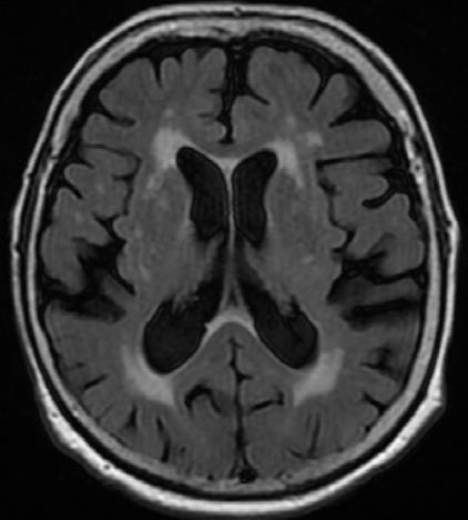 Fenotypy radiologiczne choroby małych naczyń wg STRIVE zanik
