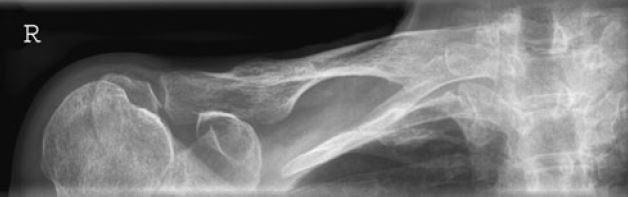 Zadanie 11. Zastosowana w badaniu radiologicznym kratka przeciwrozproszeniowa powoduje Zadanie 12. zmniejszenie ilości promieniowania rozproszonego przez co zmniejsza się kontrast obrazu.