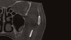 Torbiel śluzowa Sinus Implant