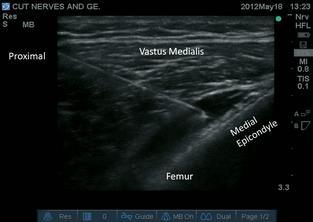 Motor Sparing Knee (MSK) Block (Chris Egeler, Swansea UK) BLOKADA: Nerwu skórnego