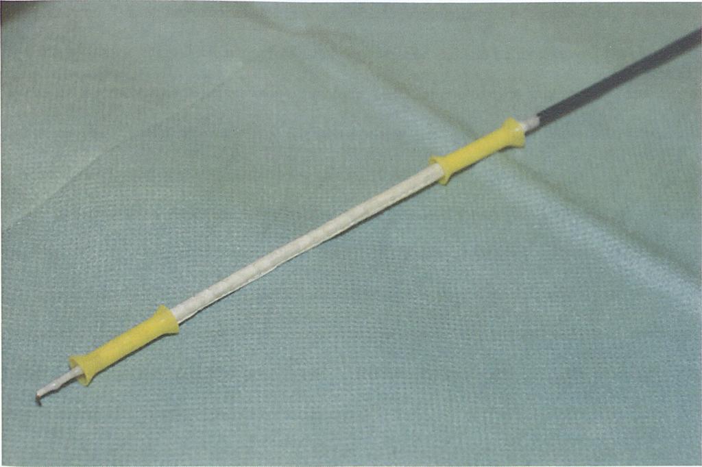 Obecnie wskazania do implantacji stent-graftu nie różnią się niczym od proponowanych dla metody klasycznej.