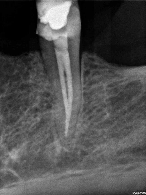 ENDODONCJA W PRAKTYCE 10 11 Ryc. 10. Pacjentka S.