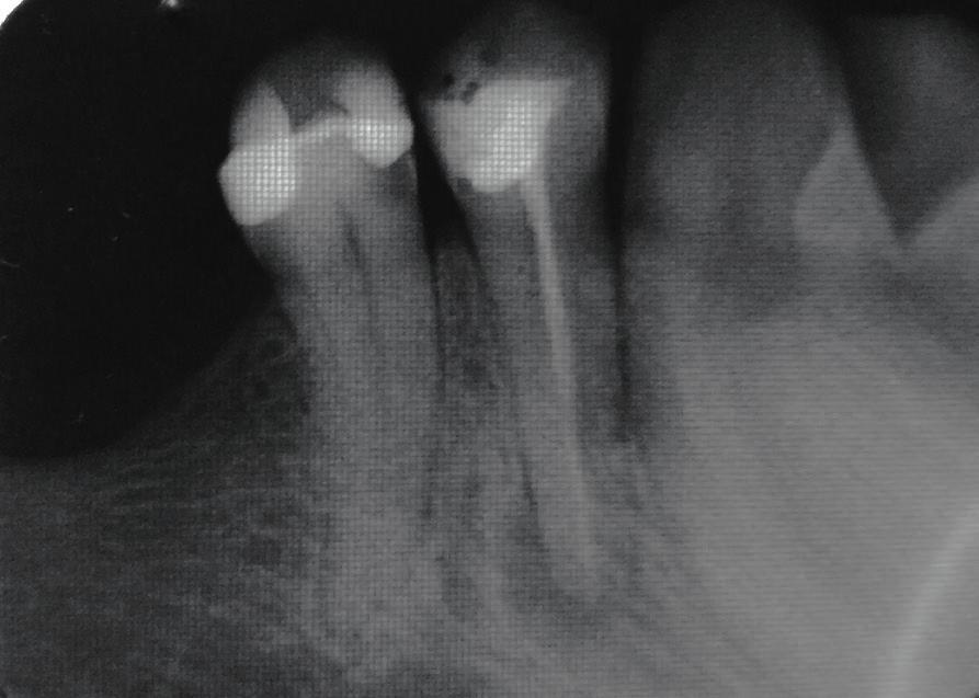 ENDODONCJA W PRAKTYCE 15 16 17 Ryc. 15. Pacjent T.