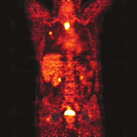 338 wspó³czesna onkologia Ryc. 1. Chory (3), lat 63, z rakiem p³askonab³onkowym prze³yku. Obraz PET/CT w przekroju czo³owym tu³owia.