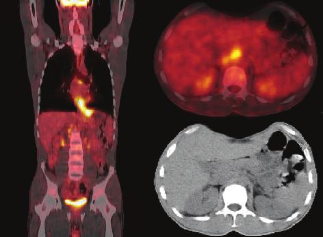 Coronal PET/CT image of the trunk (left side). Presence of increased focal FDG uptake in the upper part of the esophagus and the right lung (metastasis) Ryc. 2.