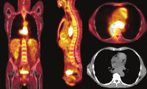 Widoczne ognisko wzmo onego wychwytu FDG w prze³yku (strona lewa) i w okolicy nadobojczykowej prawej (strona prawa) Fig. 2. Patient (5), a 51-year-old male with esophageal squamous cell carcinoma.