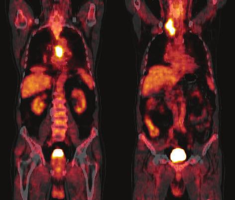Chory (10), lat 36, z gruczolakorakiem prze³yku. Obraz PET/CT tu³owia w przekroju czo³owym (strona lewa).
