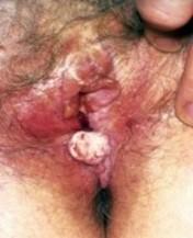 Zakażenie wirusem HPV wiąże si ę z określonymi nowotworami i chorobami Rak