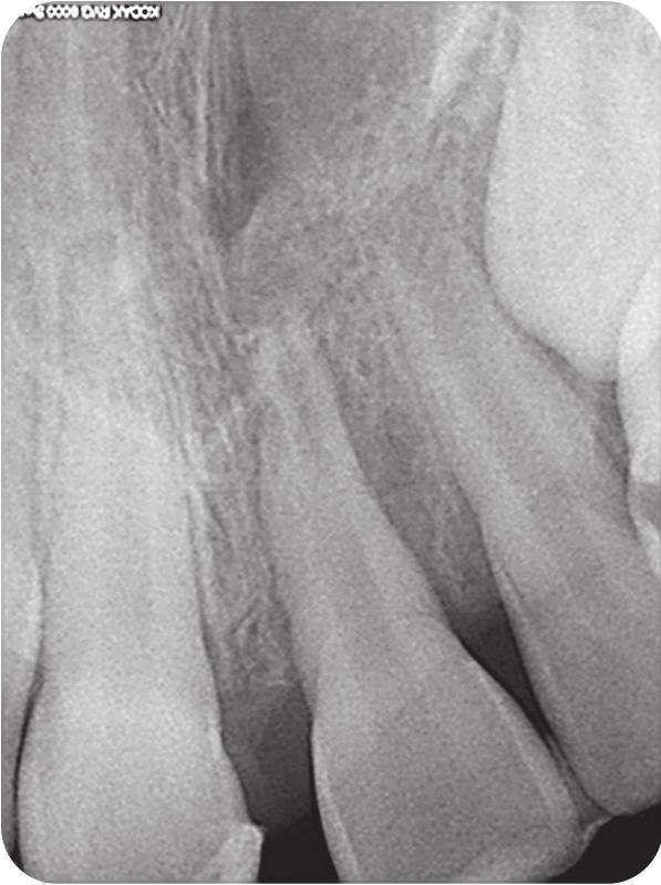 J Stoma 2015; 68, 1 Ciesielski P., Sulwińska M., Łaszkiewicz J. Fig. 1. Case 1: Tooth 21 radiograph taken on the day of the trauma after tooth replantation.