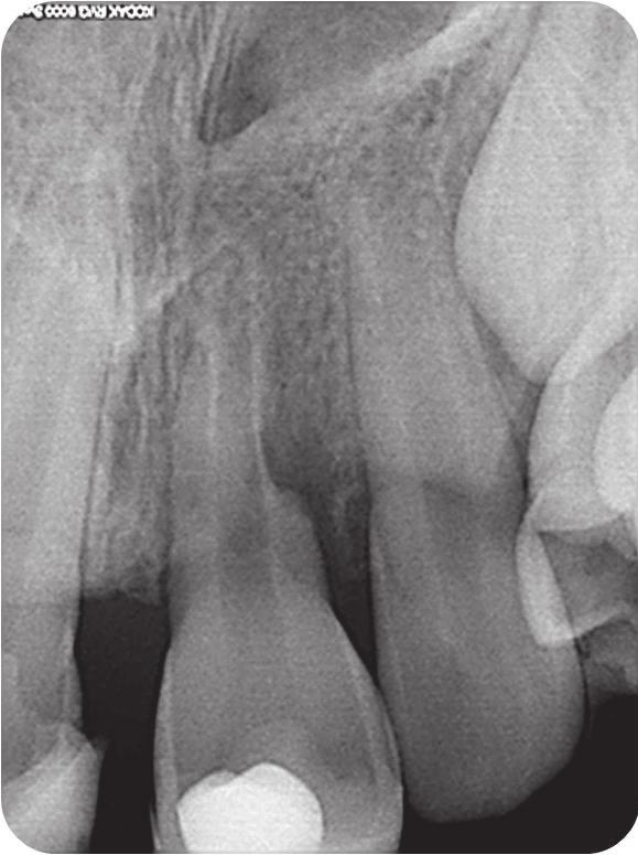 Ząb 21 zdjęcie Rtg wykonane 2 miesiące po urazie. Na dystalnej powierzchni korzenia widoczna resorpcja zewnętrzna. Fig. 3. Tooth 21 nine months after the trauma. No visible progress of resorption.