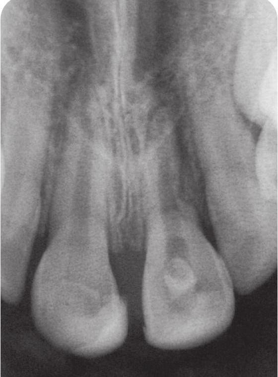 Visible extrusion of the material into periodontal space. Ząb 21 Rtg kontrolne wykonane po wypełnieniu kanału MTA. Widoczne przepchnięcie materiału do przestrzeni ozębnej.