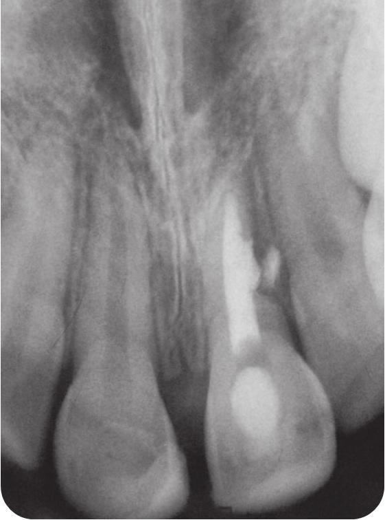 and the access cavity was obturated with Ketac Molar. An X-ray (Fig.