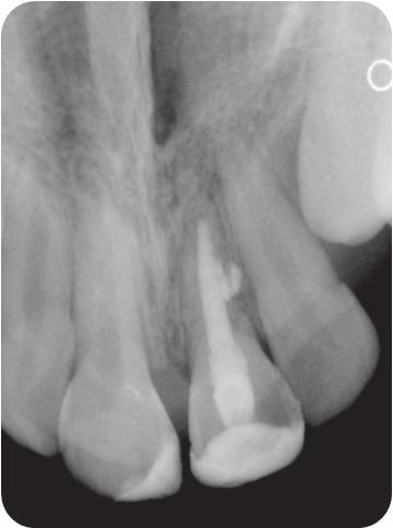 Tooth avulsion report of two cases J Stoma 2015; 68, 1 Fig. 5. Tooth 21 a 24-month follow-up radiograph. Ząb 21 kontrolne zdjęcie Rtg po upływie 24 miesięcy od urazu. Fig. 6. Tooth 21 follow-up radiograph taken 4 years and 7 months after the trauma.