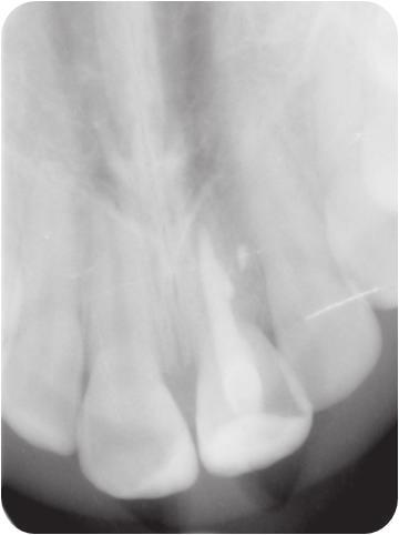The condition of tissues of the periodontium and the response of the dental pulp in teeth 12, 11, 22, 32, 31, 42, 41 to ethyl chloride were correct.