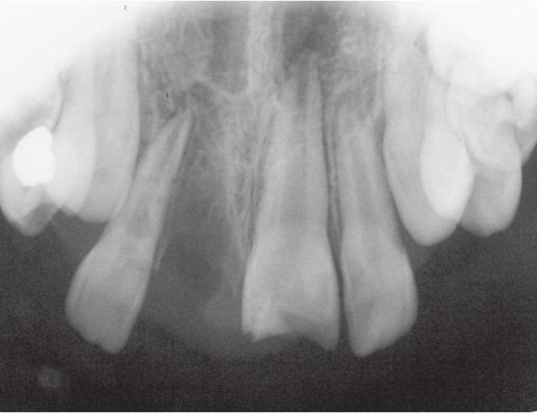 Tooth avulsion report of two cases J Stoma 2015; 68, 1 Fig. 8. Case 2: Teeth 11 and 21. Tooth 11 total luxation, tooth 21 visible intrusion and fracture of the crown. Przypadek 2: Zęby 11 i 21.