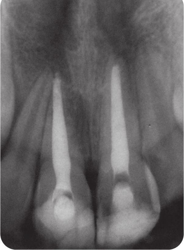 Tooth 11 ankylosis visible on the mesial aspect of the root. Zęby 11 i 21 kontrolne zdjęcie Rtg wykonane 8 miesięcy od urazu. Stan po wypełnieniu kanałów zębów 11 i 21 materiałem MTA.