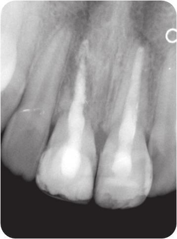 Zęby 11 i 21 kontrolne zdjęcie Rtg wykonane 2 lata i 7 miesięcy po urazie. Ząb 11 widoczny postęp ankylozy. Fig. 11. Teeth 11 and 21 radiograph taken 6 years and 4 months after the injury.